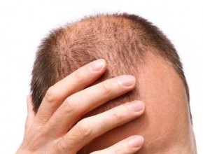 Alopecia difuză la tratament pentru femei și bărbați