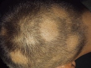 Alopecia difuză la tratament pentru femei și bărbați