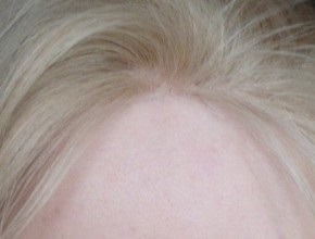 Alopecia difuză la tratament pentru femei și bărbați