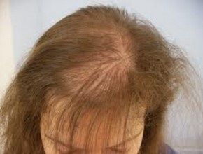 Alopecia difuză la tratament pentru femei și bărbați