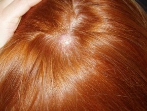 A diffúz hajhullás a nők és a férfiak kezelik