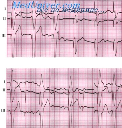 Extracorporalii pentru ECG - tratament cardiac