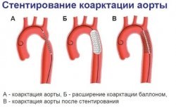 Mituri și realitate chirurgicale endovasculare