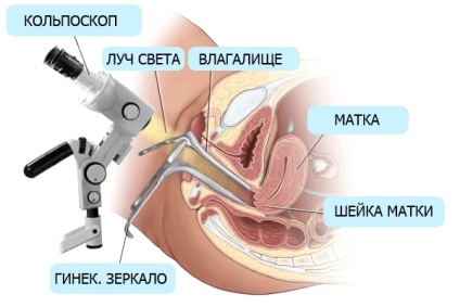 Eroziunea colului uterin și HPV, inocularea împotriva papilomului și a cancerului de col uterin