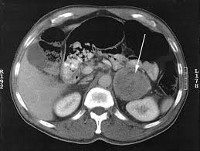 Feocromocitomul - cauze, simptome, diagnostic și tratament