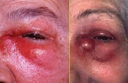 Flegmonul oftalmic - cauze, simptome, diagnostic și tratament