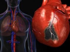 Forme de infarct miocardic