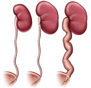 Hydronephrosis a cauzelor de rinichi, grade și etape, tratament (ceea ce este și rezultatul bolii)