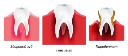 Simptomele gingivitelor și tratamentul bolilor la adulți