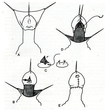 Hypospadias la copii