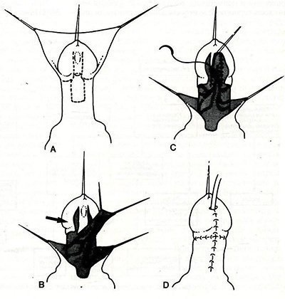 Hypospadias la copii