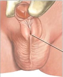 Hipospadiasul la copil cauzează forme și metode de tratament