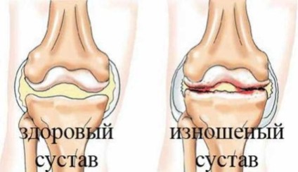 Tratamentul gonartrosis al bolii genunchiului