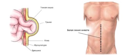 Sérv fehér vonal a has (preperitoneal lipóma) - a betegség kezelésében