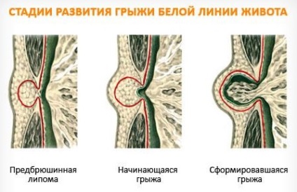 Herniarea liniei albe a abdomenului (lipom preperitoneal) - tratamentul bolii