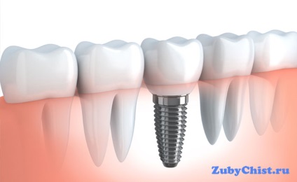 Implanturi pentru prepararea dinților, indicații, contraindicații