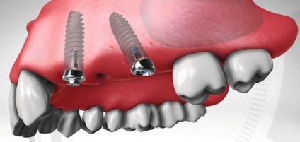 Alpha Bio implantátum - telepítés, ár, élettartam izraeli alfa bio implantátumok