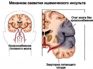 Previziunea ischemică de accident vascular cerebral pentru o viață de vârstă înaintată, sfaturi utile