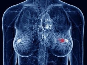 Cum se trateaza cancerul mamar, cancerul - tratamentul si prevenirea