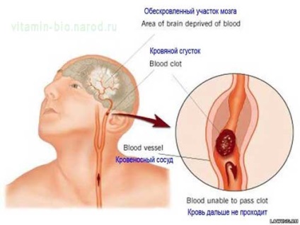 Cum de a determina un accident vascular cerebral