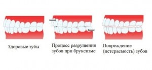 Cum să vă opriți măcinarea dinții noaptea, totul despre boala parodontală