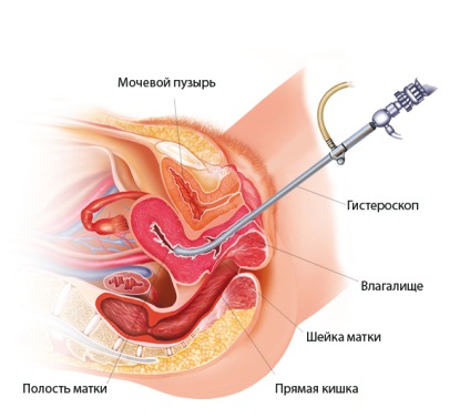 Cum este reabilitarea după histeroscopia uterului