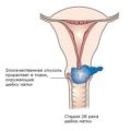 Cum să eliminați polipii de col uterin