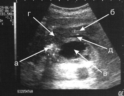 Calcificarea și tratamentul pancreatic