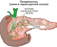 Pietrele cauzate de pancreas, simptomele și tratamentul calcificărilor fără intervenție chirurgicală
