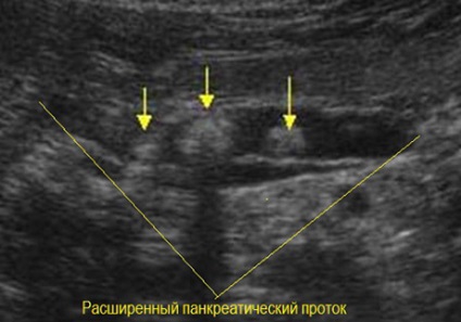 Pietrele cauzate de pancreas, simptomele și tratamentul calcificărilor fără intervenție chirurgicală