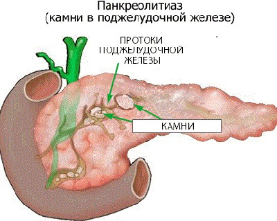 Pietrele cauzate de pancreas, simptomele și tratamentul calcificărilor fără intervenție chirurgicală