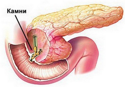 Pietrele din pancreas cauzează, simptome, tratament