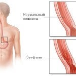 Esofagită simptomatică și cauze ale bolii