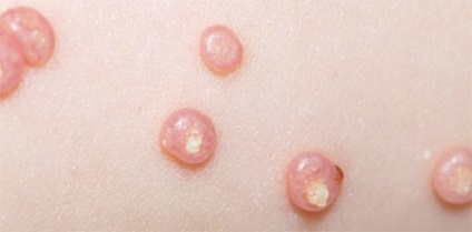 Molluscum contagiosum képeket, okok, kezelés