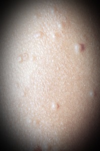 Molluscum contagiosum, a helyszínen az egészséges bőr