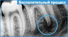 Canalele radiculare, pulpa dentară, canalele radiculare, pulpa dentară, tratamentul canalului radicular