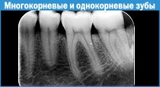 Canalele radiculare, pulpa dentară, canalele radiculare, pulpa dentară, tratamentul canalului radicular