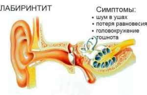 Semne, simptome și tratament pentru labirintită la copii și adulți