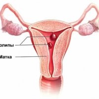 Tratamentul polipului cervical - scalpel - informație medicală și portal educațional