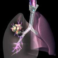 Tratamentul cancerului pulmonar 4 grade