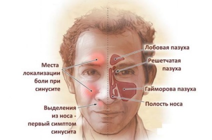 Tratamentul sinuzitei și frigului prelungit cu medicamente și remedii populare la adulți și copii,