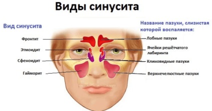 Tratamentul sinuzitei și frigului prelungit cu medicamente și remedii populare la adulți și copii,