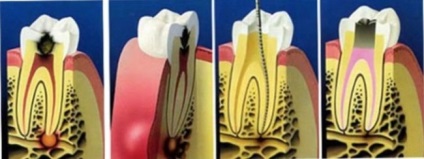 Specificitatea microbiană a parodontitei, medicina populară