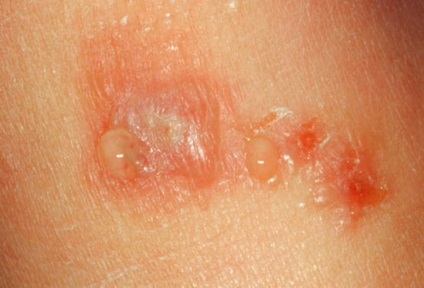 Wetting eczema in zona inghinala - principalele simptome