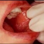 A szájpenész a szájába egy gyermek okoz és kezelés