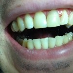 Extinderea dinților în Ekaterinburg