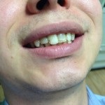 Extinderea dinților în Ekaterinburg