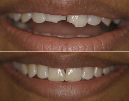 Extinderea dinților va reveni un zâmbet frumos