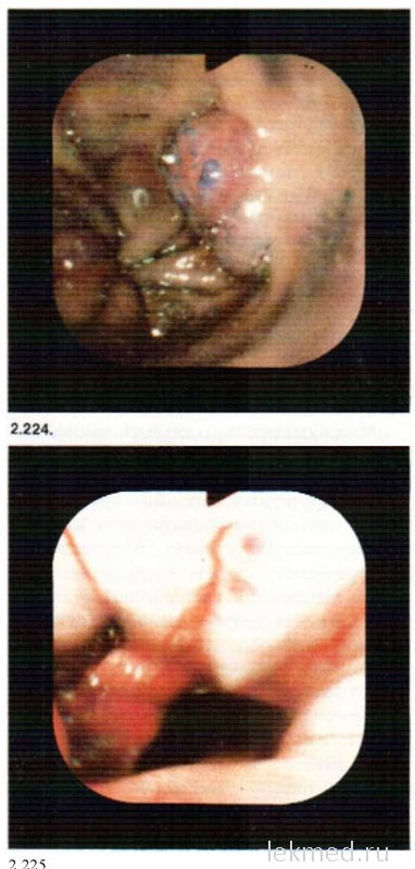 Endoscopia urgenta a sangerarii in tractul gastro-intestinal - Un ghid clinic