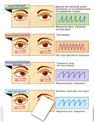 Nystagmus leírás, a diagnózis és a kezelés a betegség